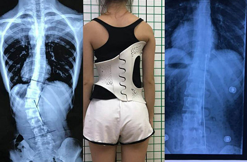 3D打印技術(shù)在骨科的實際應(yīng)用有哪些？(圖4)